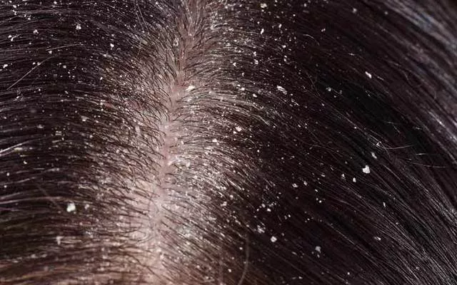 Dandruff की वजह से बाल क्यों झाड़ने लगते हैं