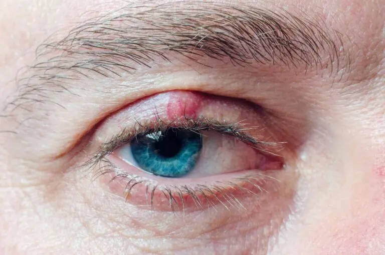 Chalazion ( पलक पर गांठ ) के कारण, लक्षण, जोखिम कारक और उपचार