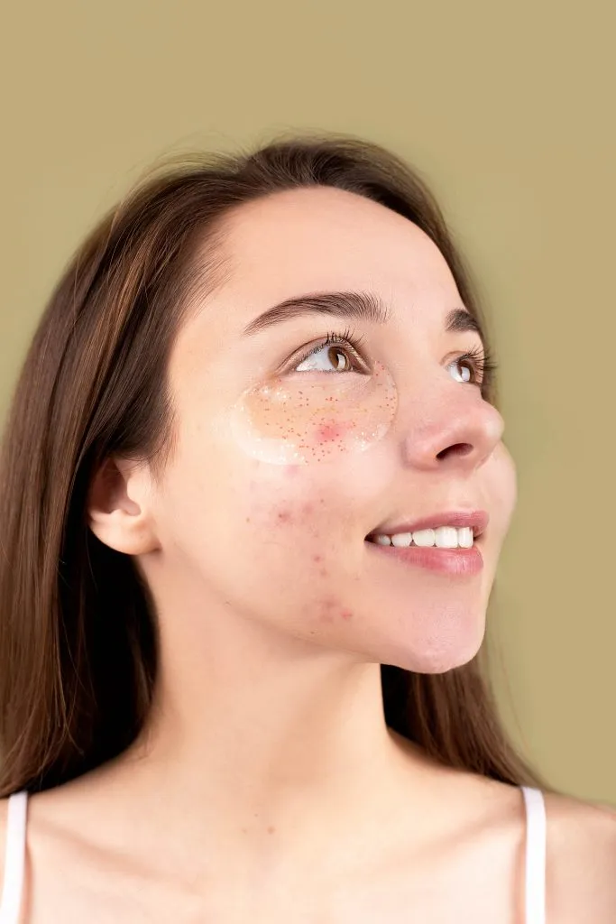 5 methods to remove pimples and acne from face in Hindi