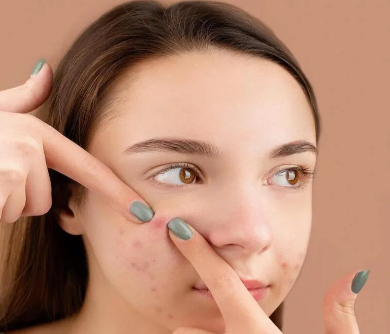 Causes of pimples in Hindi