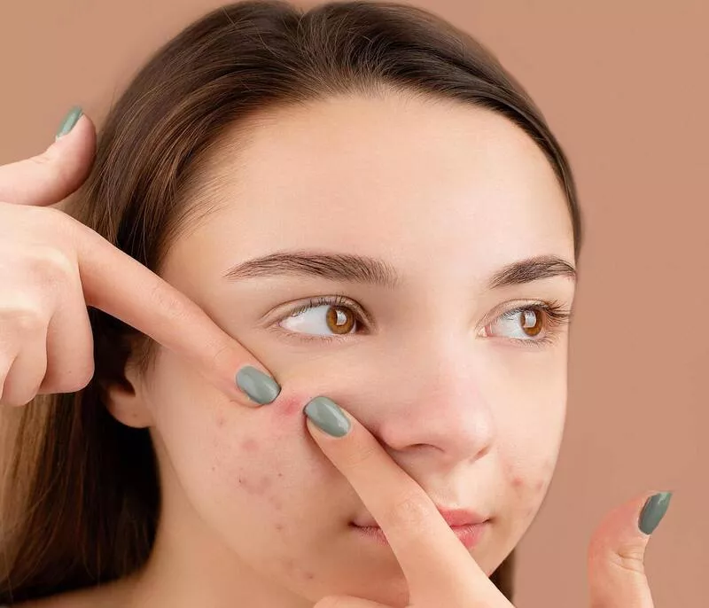 Causes of pimples in Hindi